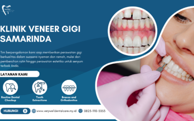 Klinik Veneer Gigi Samarinda untuk Senyum Putih dan Natural