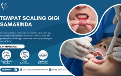 Tempat Scaling Gigi Samarinda untuk Gigi Bersih dan Sehat