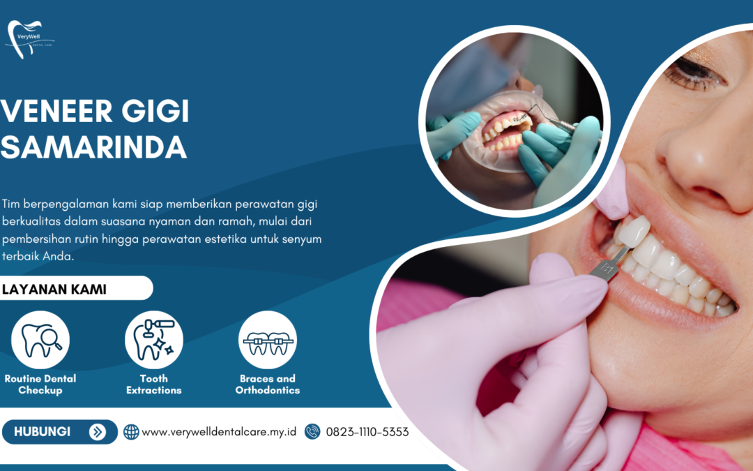 Veneer Gigi Samarinda