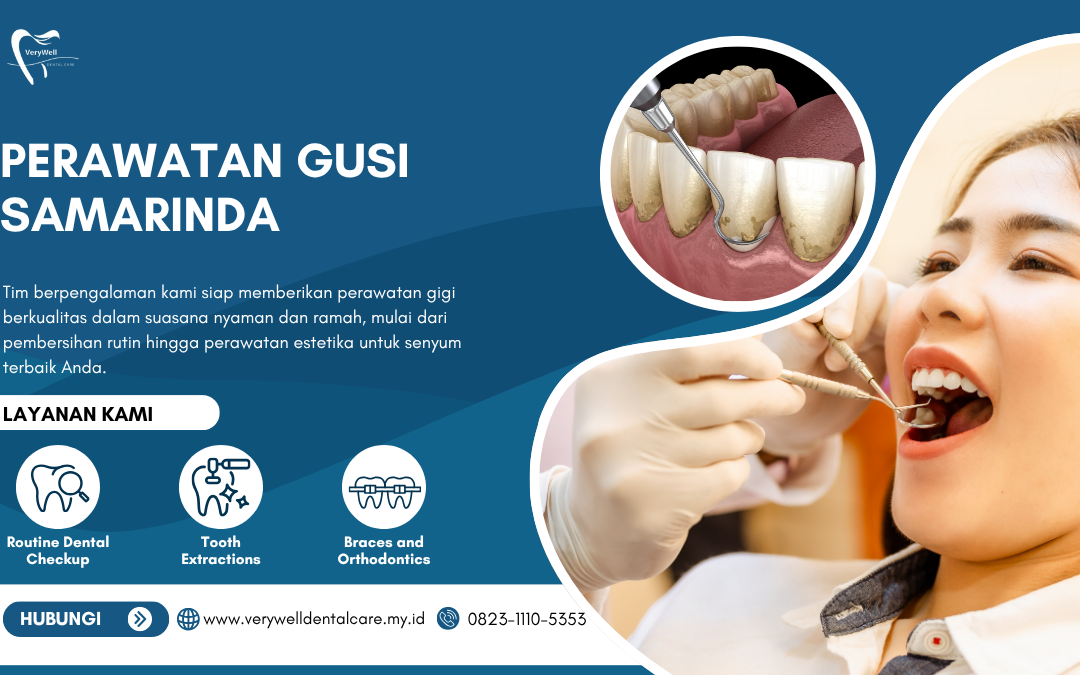 Perawatan Gusi Samarinda
